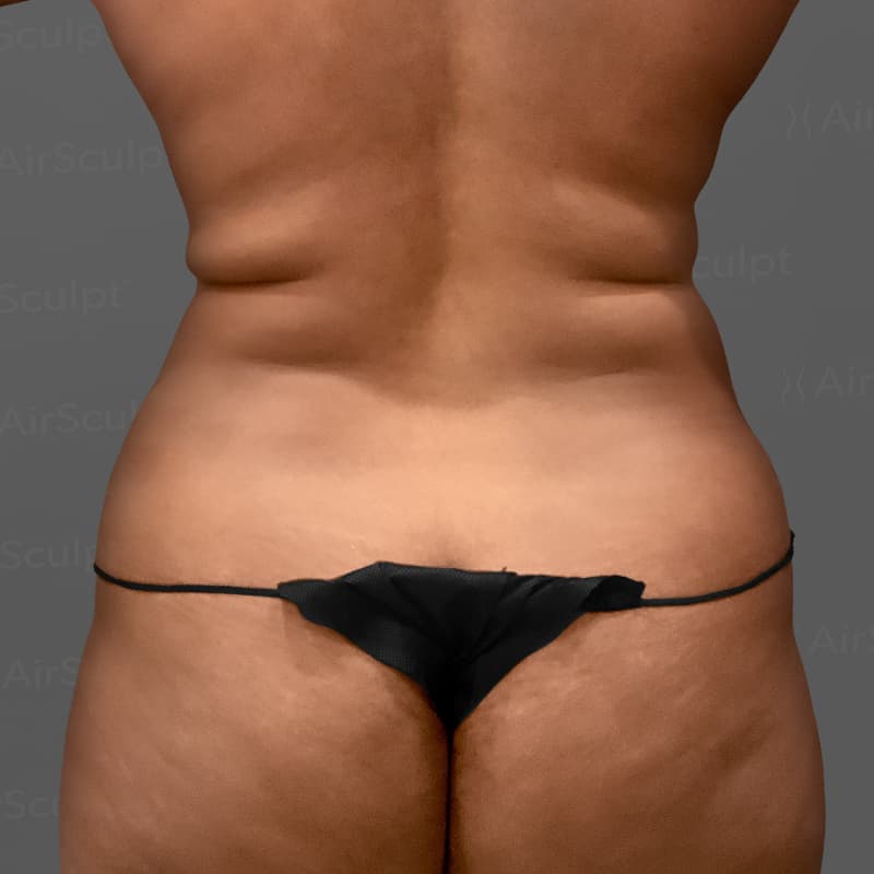 Back AirSculpt before