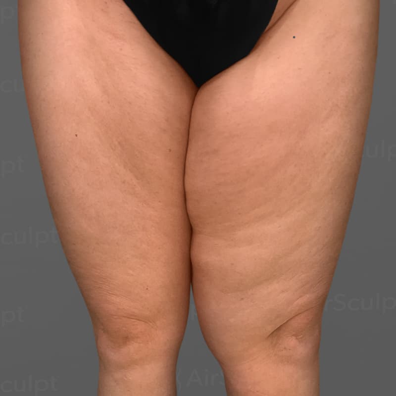 Thighs AirSculpt before