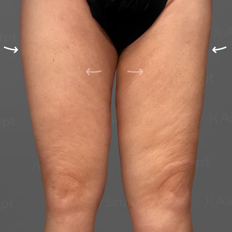 Thighs AirSculpt after