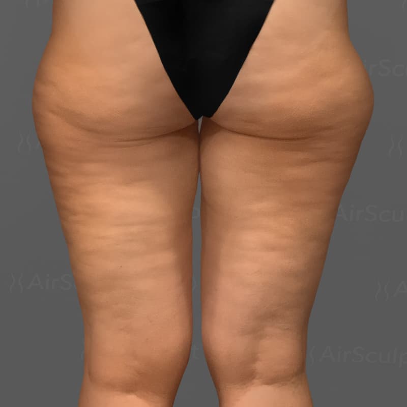 Thighs AirSculpt+ before