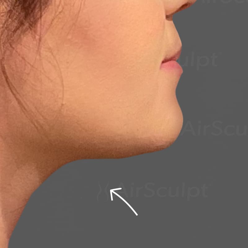 Chin AirSculpt after