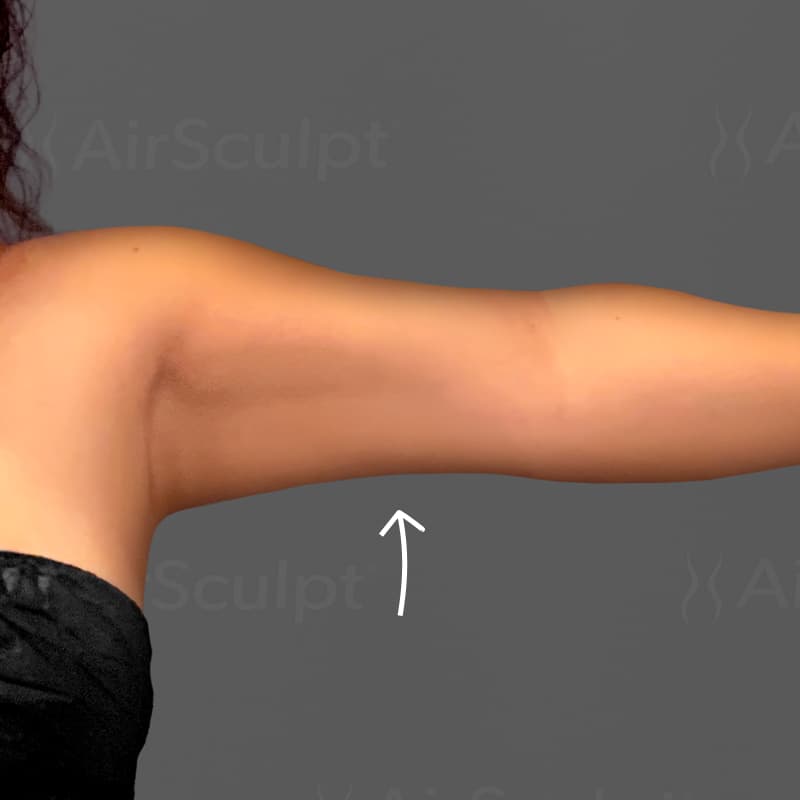 Arms after