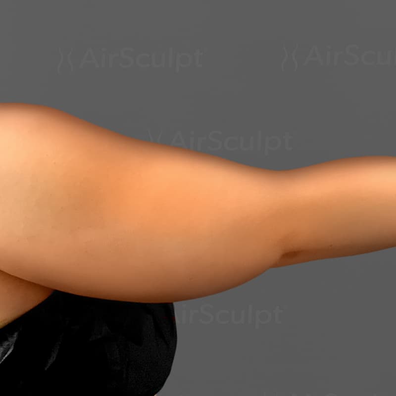 Arm AirSculpt+ before