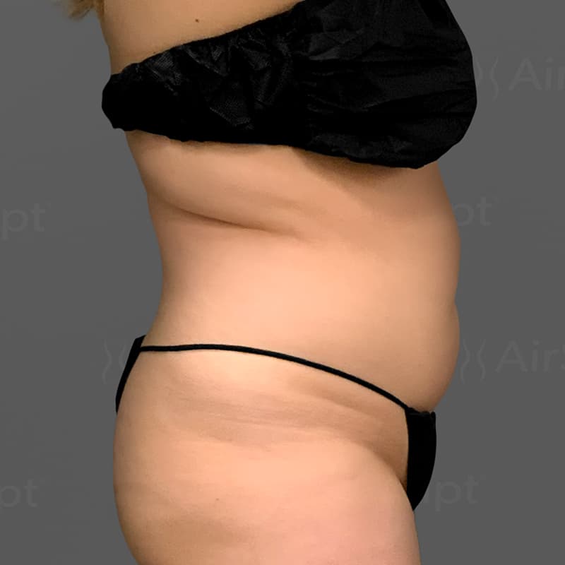 Stomach AirSculpt before