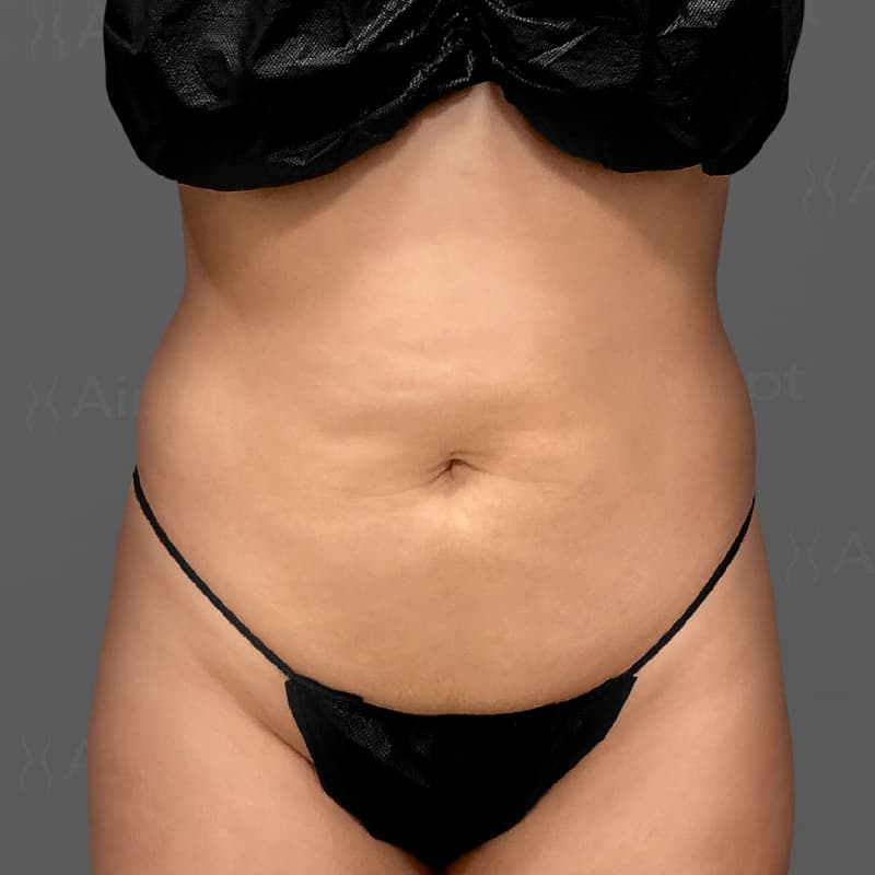 Stomach AirSculpt+ before