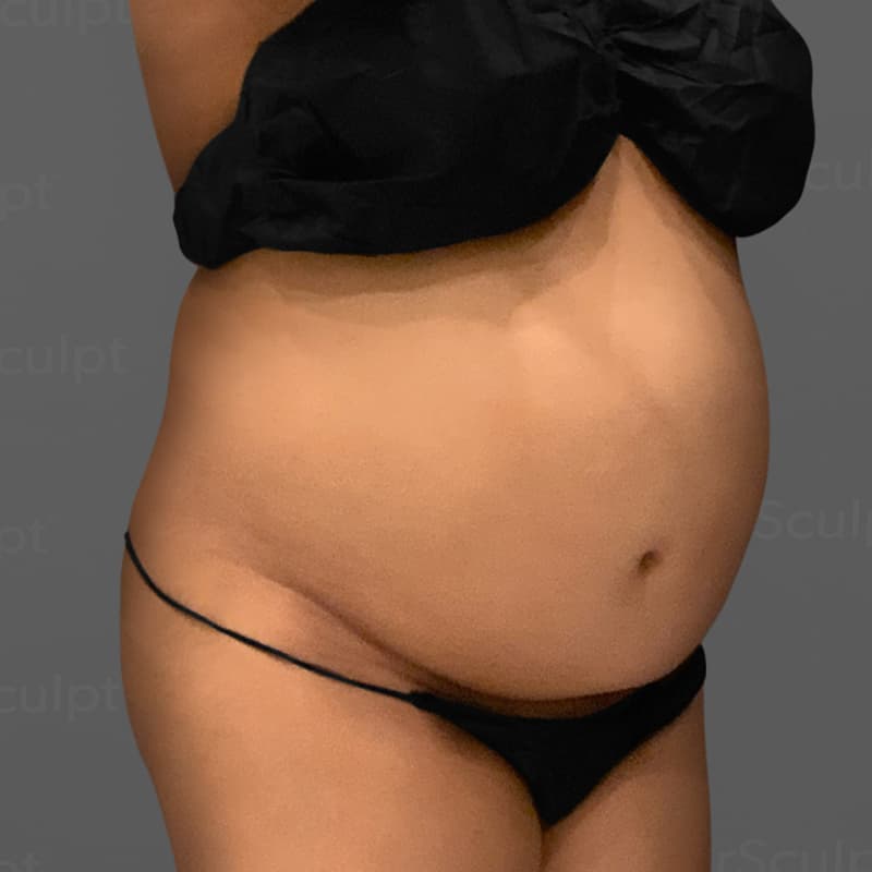 Stomach AirSculpt+ before