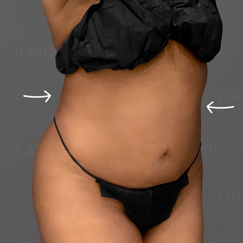 Stomach AirSculpt+ after