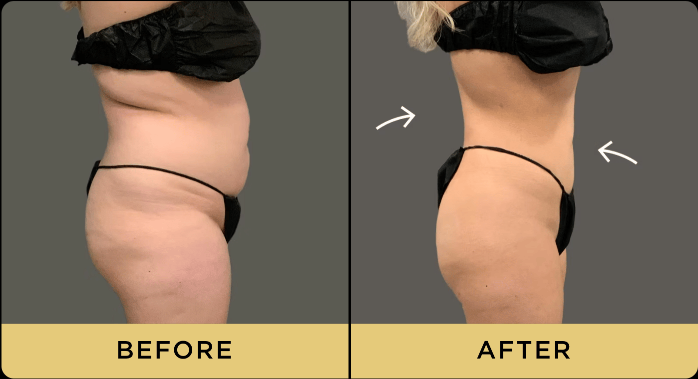 Before and Afters